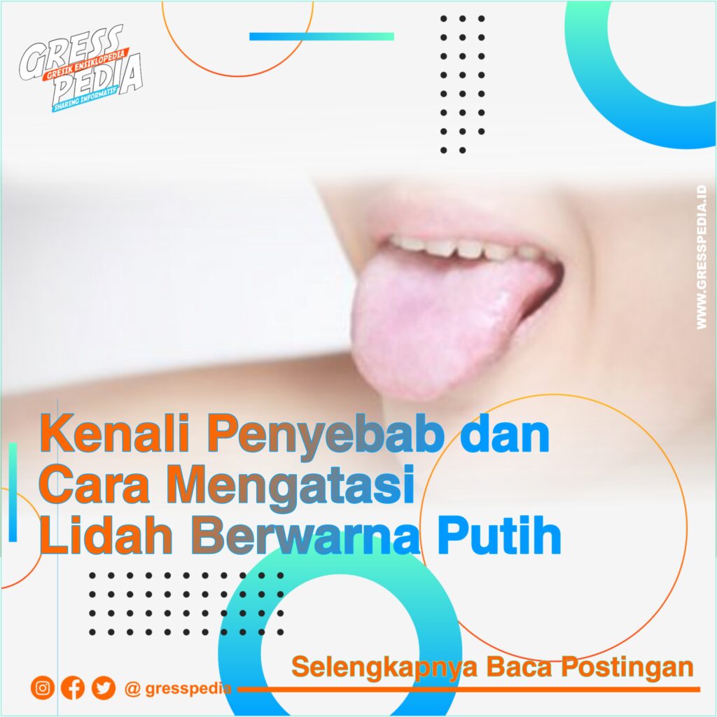 Kenali Penyebab dan Cara Mengatasi Lidah Berwarna Putih